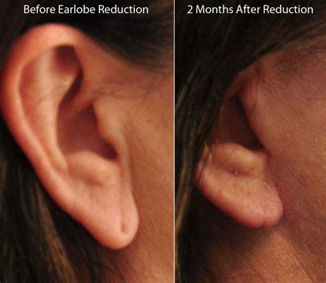Photos Before And After Earlobe Surgery