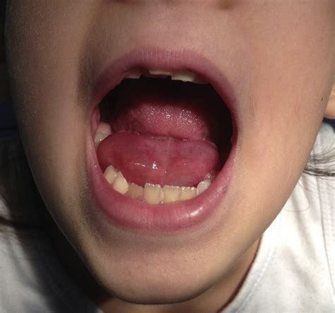 An Unusual Oral Swelling The Journal Of Pediatrics