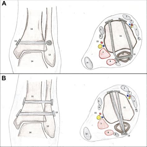 Biomechanical Evaluation Of A New Suture Button Technique For Reduction And Stabilization Of The