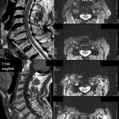 Postoperative Ct Scan Of The Cervical Spine Normal Cervical Anterior