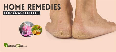 10 Best Home Remedies For Cracked Feet That Work Fast Naturally