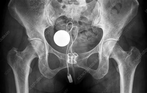 Artificial Urinary Sphincter X Ray Stock Image C0096768 Science