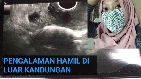 Pengalaman Hamil Di Luar Kandungan Hamil Ektopik Youtube