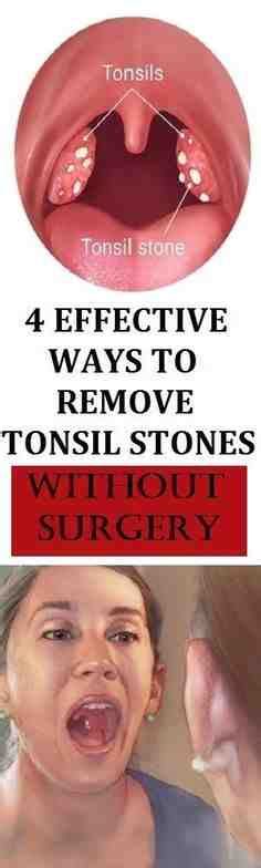 White Spot Tonsil Sore Throat For Tips Tonsillectomy Recovering V