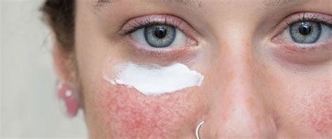 Step By Step Guide To Eyelid Dermatitis Treatment Delfina Skin™