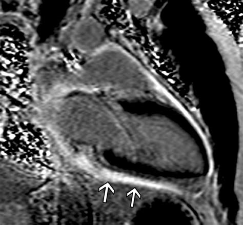 Pericarditis Cardiac Mri Radrounds Radiology Network