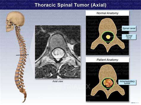 Thoracic Spinal Tumor Axial Trialexhibits Inc