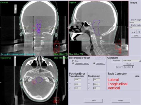 Cone Beam Computed Tomography Cbct Matched With The Planning Ct Using