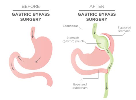 Gastric Bypass Surgery And Cost The Surgical Weight Loss Centre