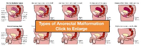 Pediatric Surgery Anorectal Malformation