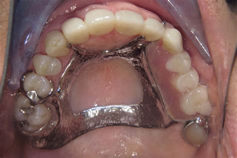 Removable Partial Dentures Smile Gallery Raber Dental Kidron Dentist