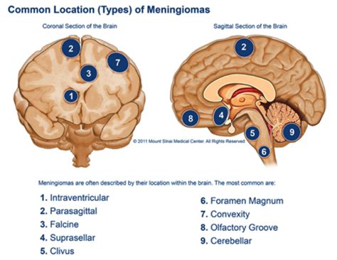 Neurosurgery Tasmania Meningioma