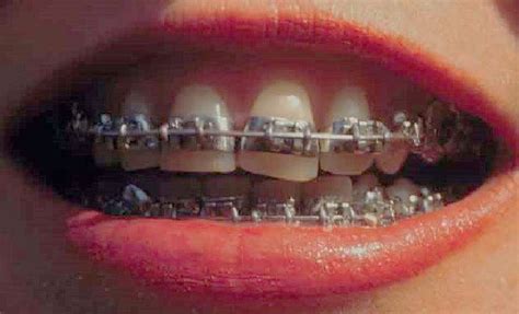 Fully Banded Braces 1970s 1980s Orthodontics Dental Braces Orthodontics Braces Orthodontics
