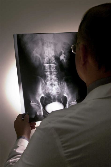 Prostate Cancer And X Rays
