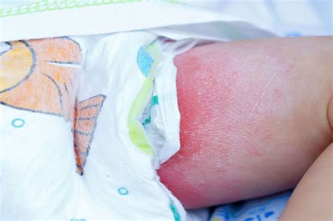 Pics Of Diaper Rash Understanding The Common Skin Condition In Babies
