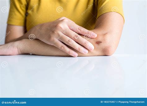 Woman Showing Wound On Her Armscab Becomes Infected Stock Image