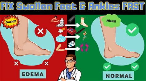 Edema Fix Swollen Feet Swollen Ankles And Swollen Legs Fast