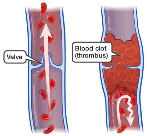 Trombosis Venosa Superficial Centro Vascular Y Endovascular The
