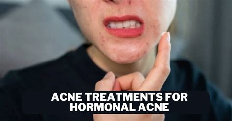 Acne Treatments For Hormonal Acne A Comprehensive Guide Beauty Skin Lab