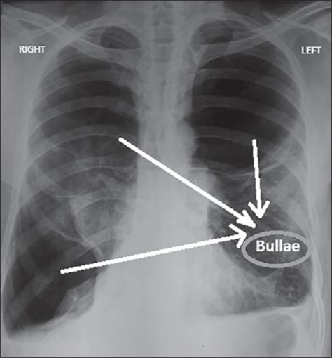 Preoperative Chest X Ray Showing Bullae In Right Upper Open I