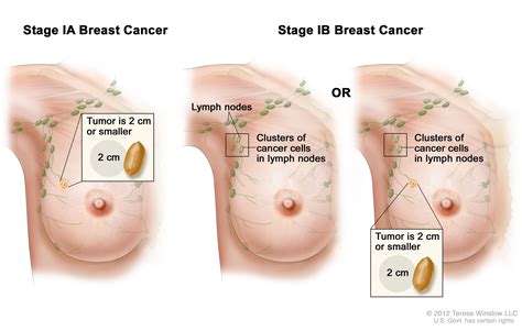 Stages are numbers used to describe how far a cancer has advanced and where it has spread in the body. Breast Cancer During Pregnancy (PDQ®)—Patient Version ...
