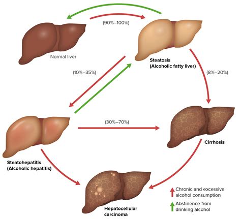 Alcoholic Liver Disease Concise Medical Knowledge