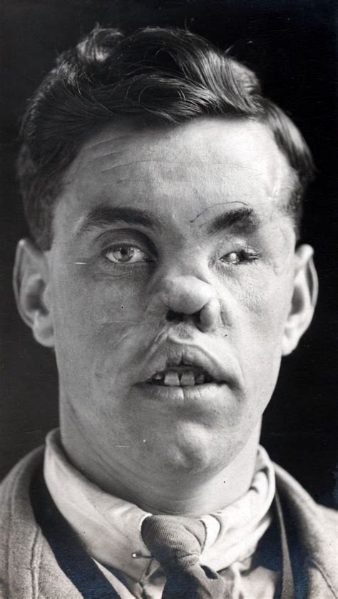 Ww1 Plastic Surgery Pictures
