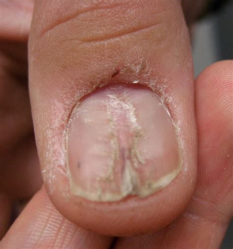 An Atlas Of Nail Disorders Part 2 Consultant360