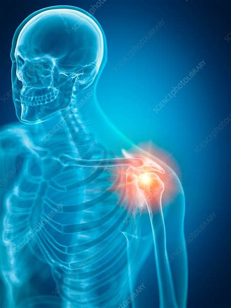 Illustration Of A Painful Shoulder Stock Image F0238470 Science