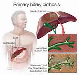 Photos of Holistic Treatment For Cirrhosis Of The Liver