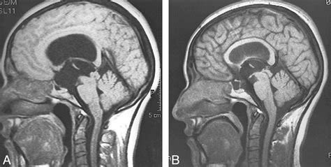 Morphometric Study Of The Midsagittal Mr Imaging Plane In Cases Of