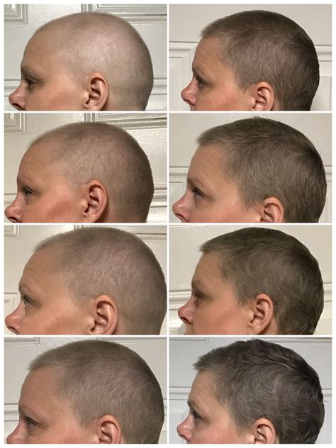 How Long Does It Take For Hair Loss After Chemo The Definitive Guide