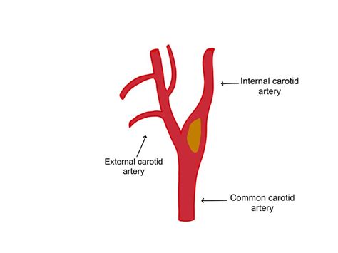 The Common Carotid Artery Splits Into The External Carotid Artery And
