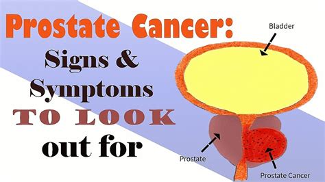 Prostate Cancer Signs And Symptoms To Look Out For Youtube