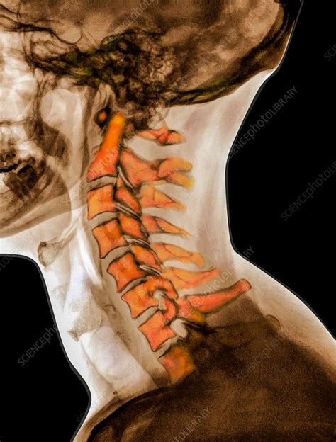 Curvature Of The Cervical Spine X Ray Stock Image C0308554