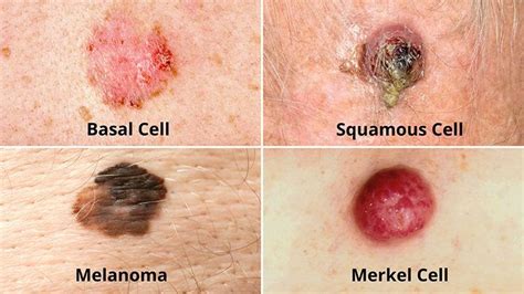 What Does Skin Cancer On The Nose Look Like Pictures Skin Cancers On