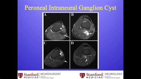 Stanford Neurosurgeon Explains Common Peroneal Neuropathy And Presents