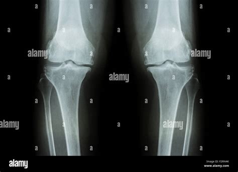 Osteoarthritis Knee Oa Knee Film X Ray Both Knee Front View