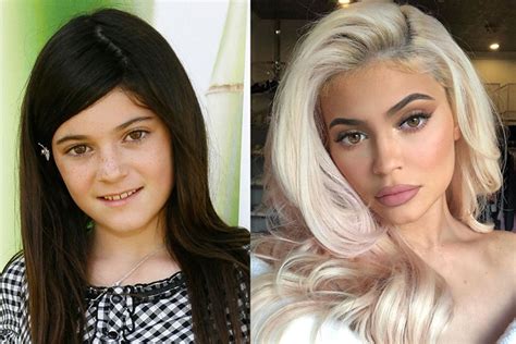 You can see how drastic the change on her look by seeing the before and after picture. Kylie Jenner Before And After Plastic Surgery » Celebrity Plastic Surgery