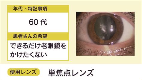 白内障手術 症例 代 単焦点レンズ 老眼と白内障福岡市南区の望月眼科