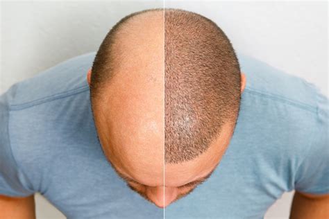 Greffe De Cheveux Turquie : Les Dangers Du Tourisme Médical - The Clinic