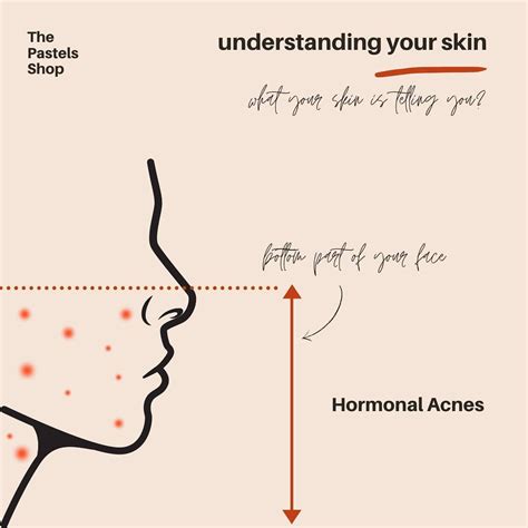 Understanding Your Skin Hormonal Acne The Pastels Shop