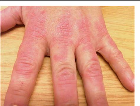 Rheumatoid Arthritis Rash On Hands My Xxx Hot Girl