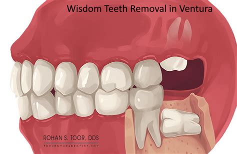 Ventura Wisdom Teeth Removal Cost Symptoms Recovery Oral Surgery