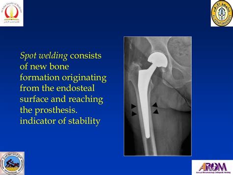 Thigh Pain After Total Hip Arthroplasty Autosaved