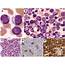 Plasma Cell Neoplasm With Plasmablastic Morphology Mimicking Acute Leukemia