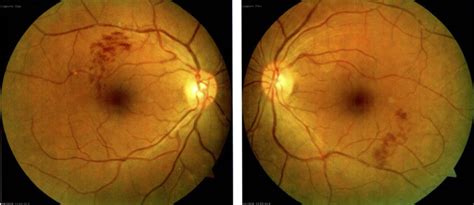 Retinal Vein Occlusion Causes Symptoms Diagnosis Treatment Prognosis
