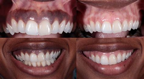 5 Amazing Facts About Treating Dark Gums In Memphis Tn