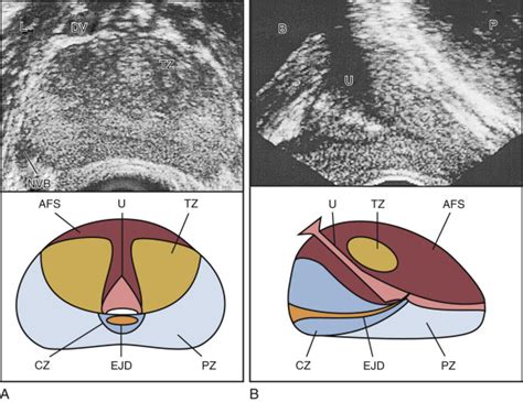 Transrectal Ultrasound Directed Prostate Biopsy Abdominal Key