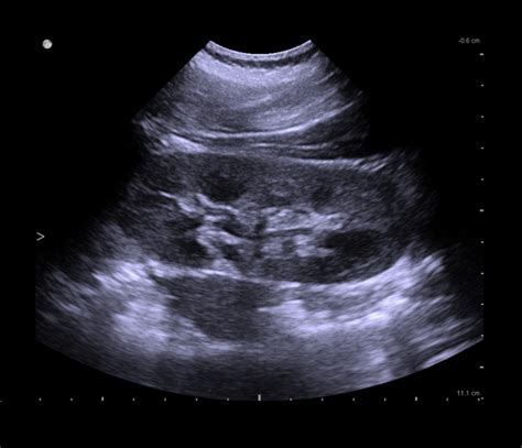 Ultrasound For Kidney Bk Medical